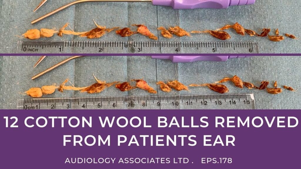 Cotton Ball Earwax Removal 1