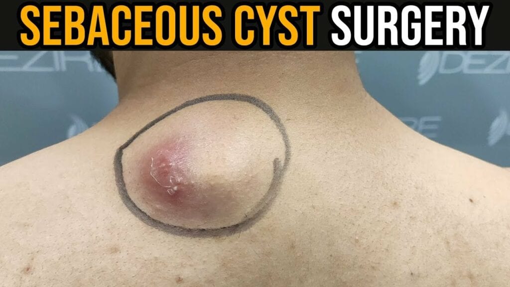 Massive Back Boil or Sebaceous Cyst? 1