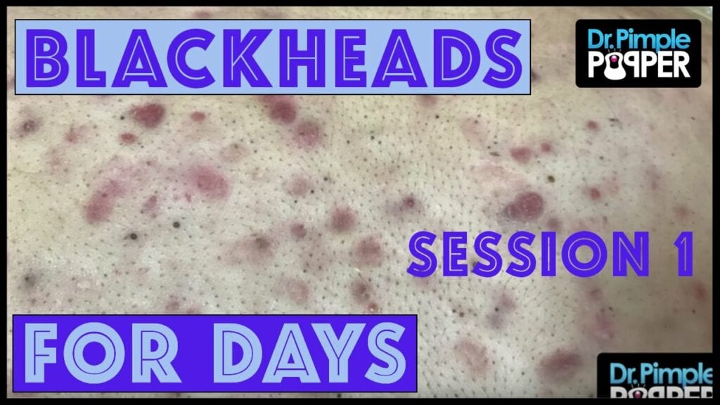 So Many Blackheads! 1
