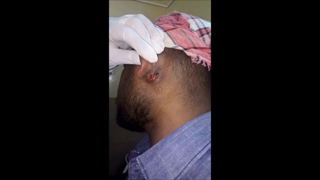 ABSCESS BEHIND THE EAR 1