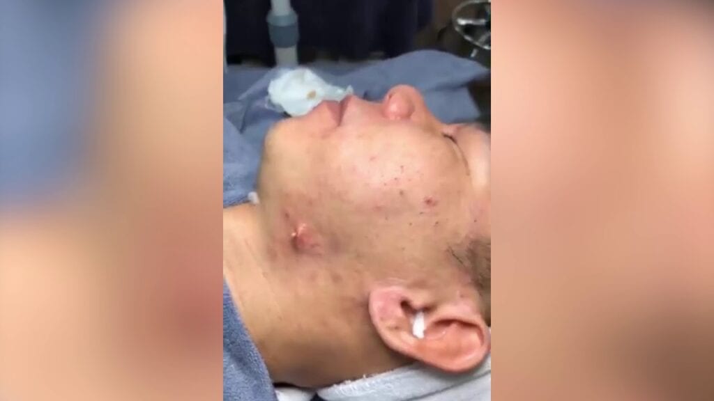 Neck Zit 1