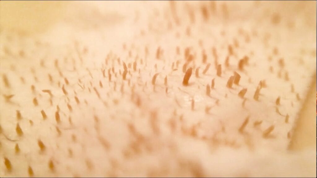 Pore Strip Removal 1