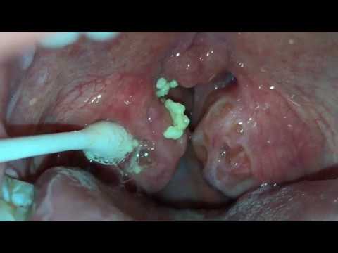 A world of tonsil stones 1