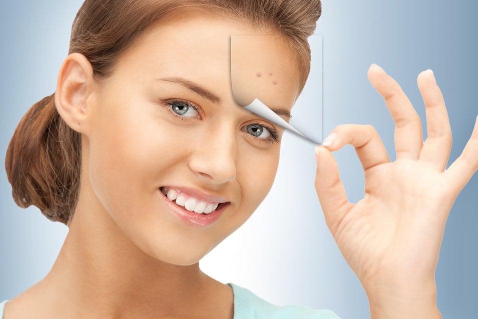 5 Surprising Ways To Cure Acne 1