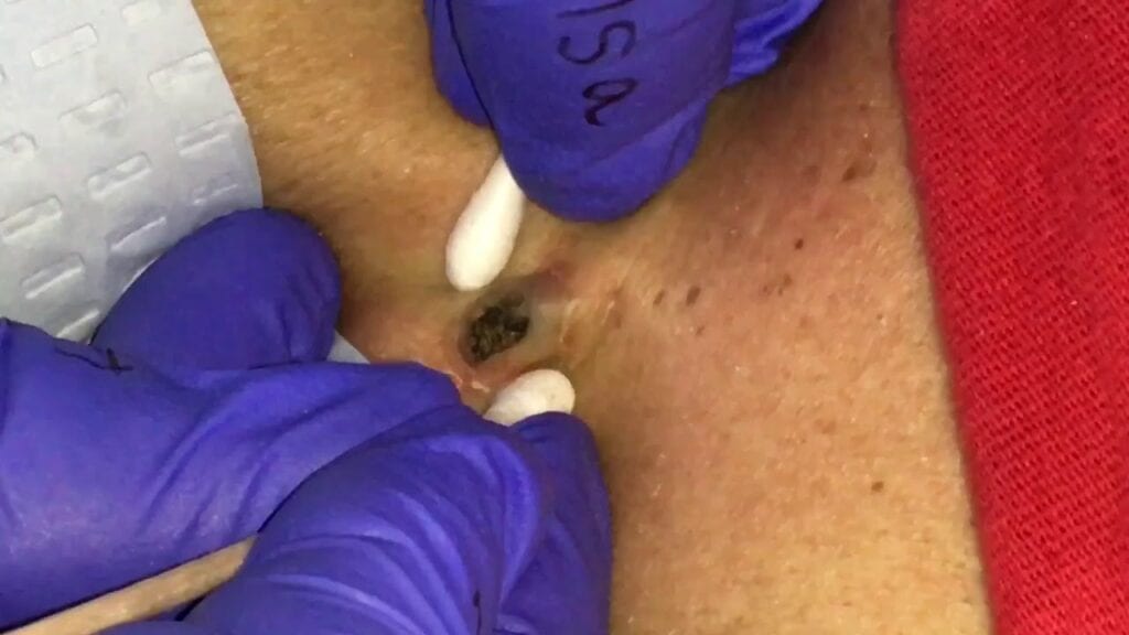 Dilated Pore of Winer 2 Dilated Pore of Winer 1