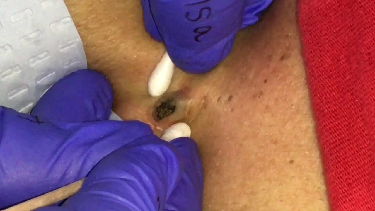 Dilated Pore of Winer 1 Dilated Pore of Winer 1