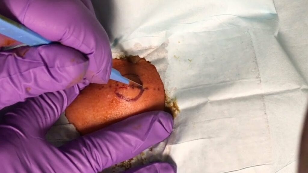 Huge, old neck cyst drained. 1