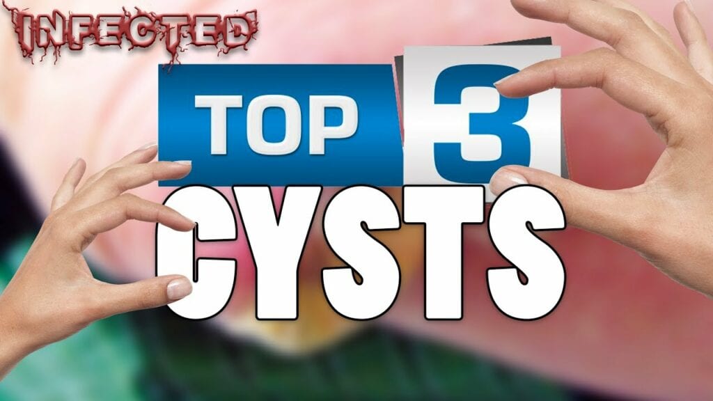 Infected Cysts, Pimples & More wit Dr. Gilmore 1