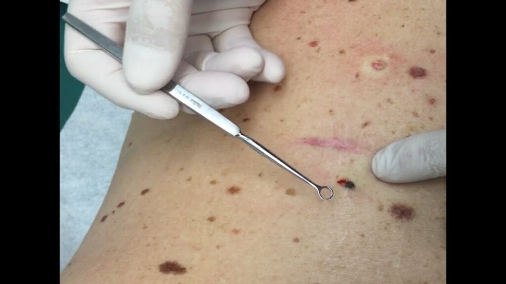 Pore of Winer Extractions 1