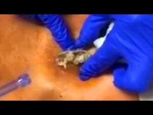 Unbelievable Cyst - Pop That Zit - Since 2006!