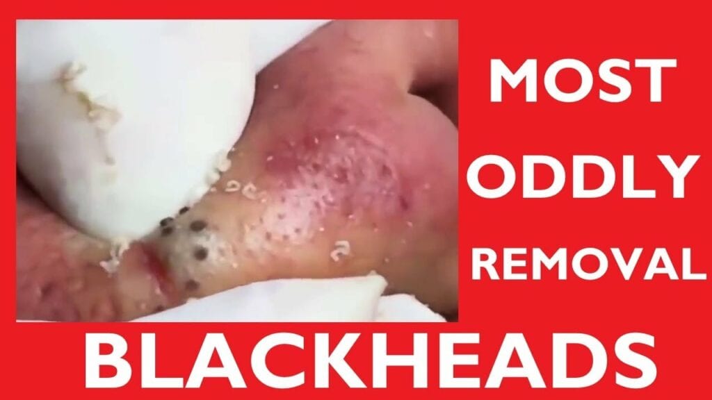 Blackhead Compilation 1