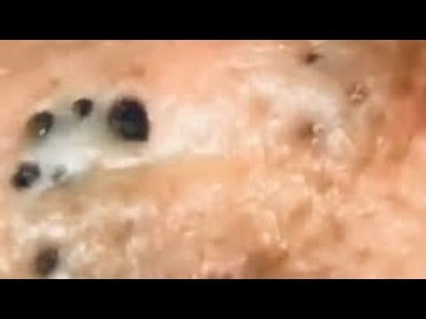 Digging blackheads out of pores 2 Digging blackheads out of pores 1