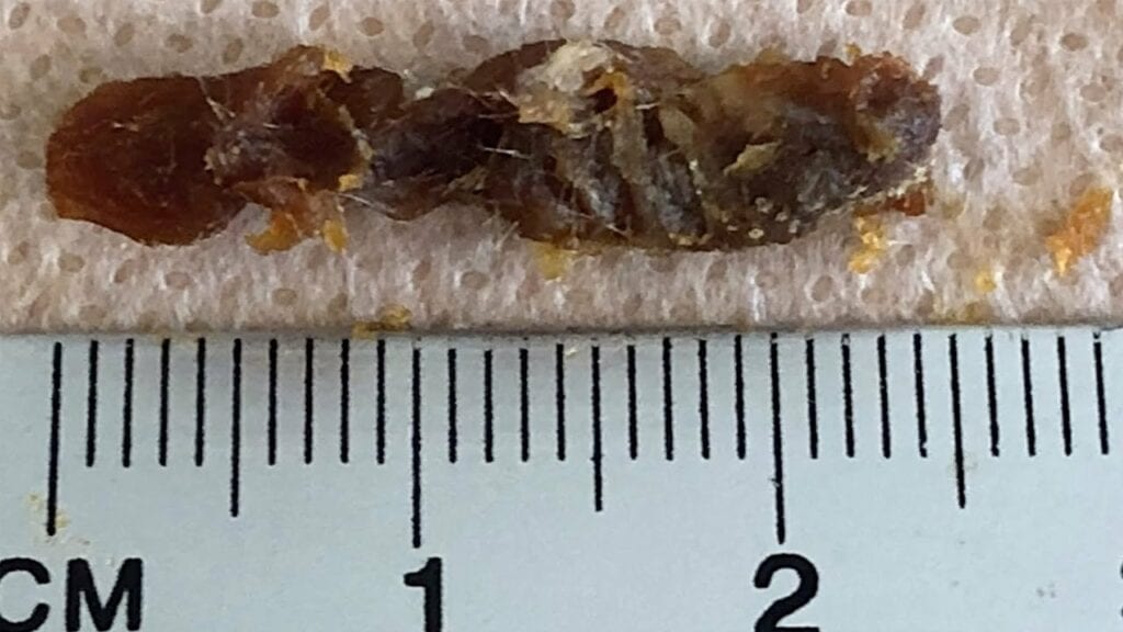 Huge Earwax Removal 1