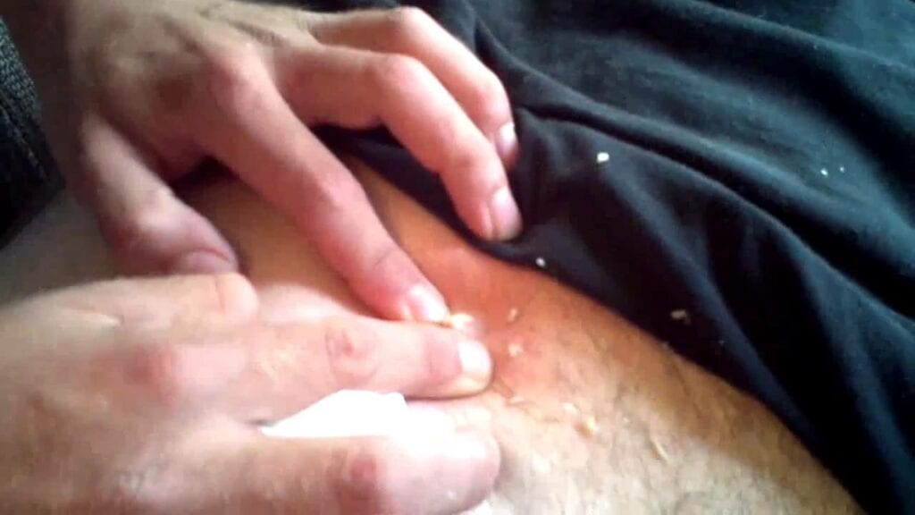 Juicy Back Zit 1