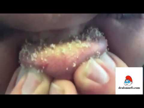 Parmesan Cheese Nose: Pores 1