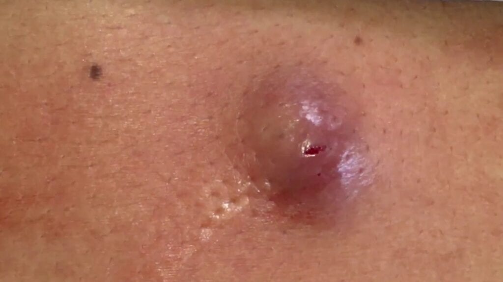 Squirting Cyst 1