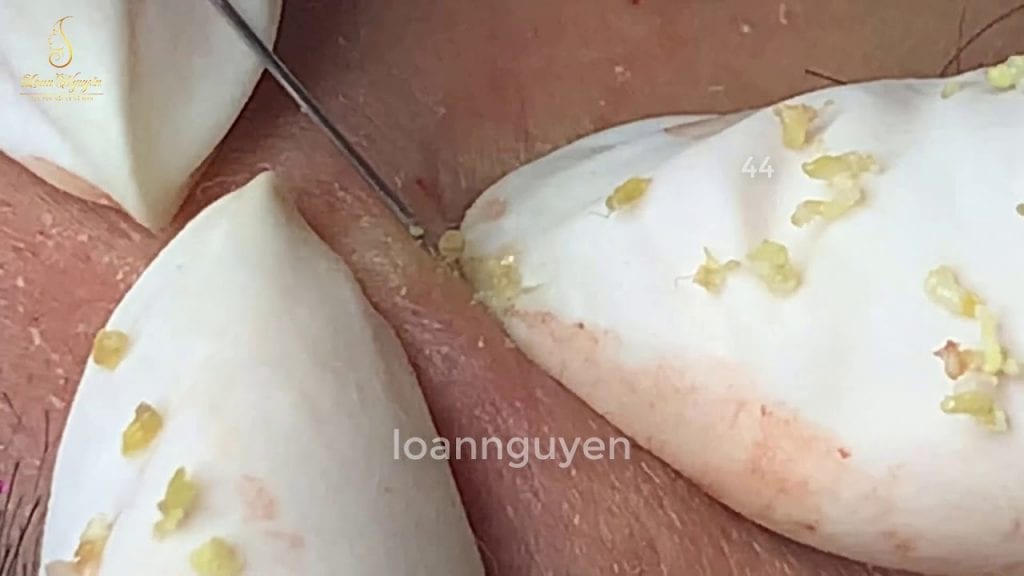 Acne Spa 2 Acne Spa 1