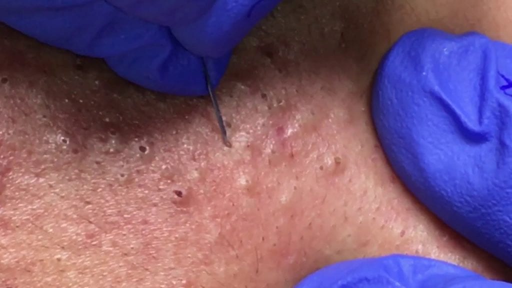 Blackhead Skin Treatment 1