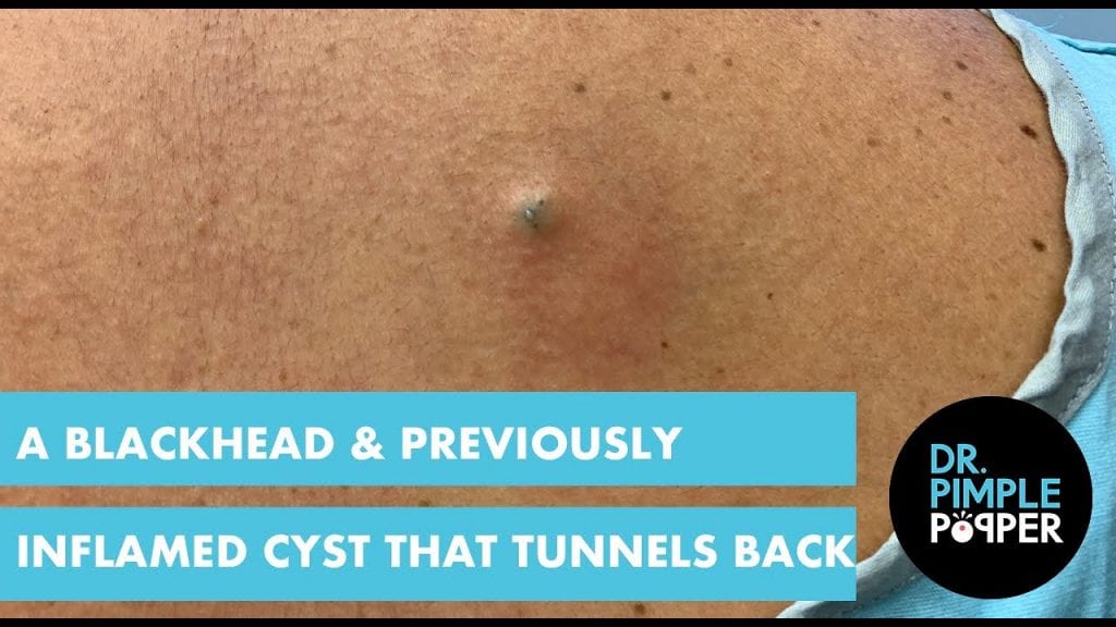 The Magic Cyst 1