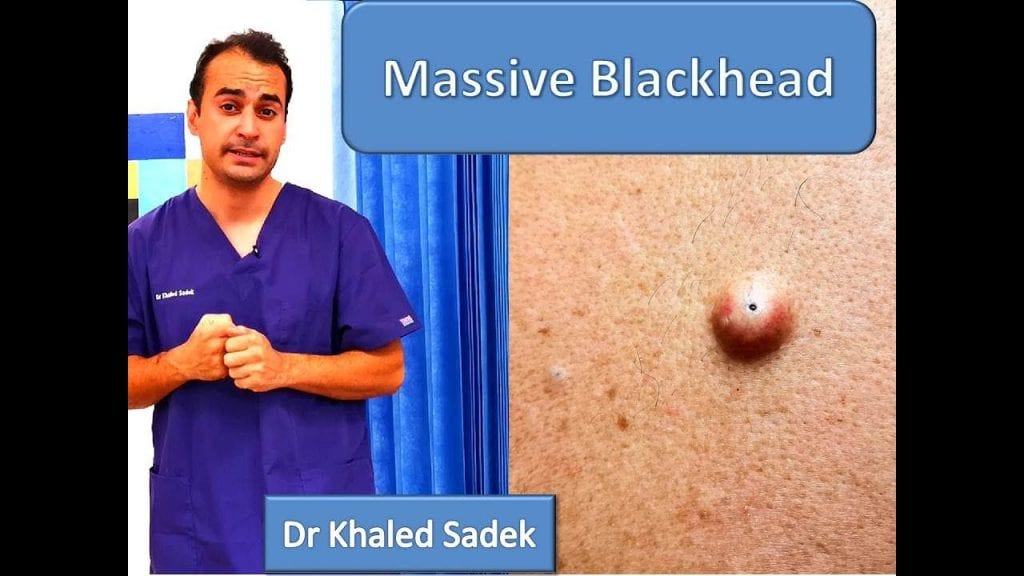 Blackhead Removal - Doctor Khaled Sadek 1