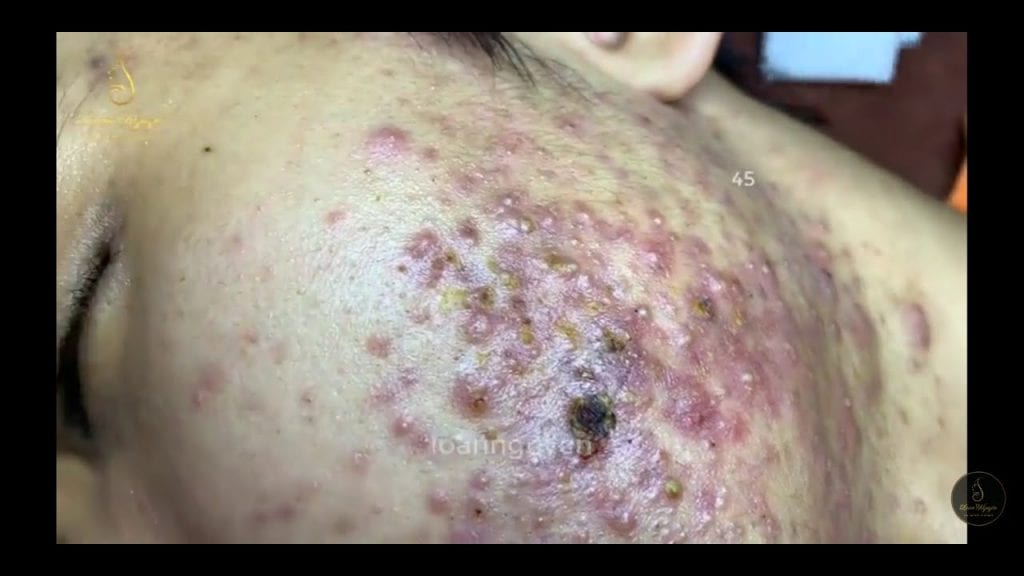 Cystic Acne Treatment 1