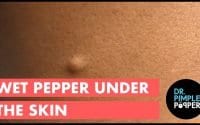 Dr. Pimple Popper, what’s a wet pepper? 1 Dr. Pimple Popper, what’s a wet pepper? 1