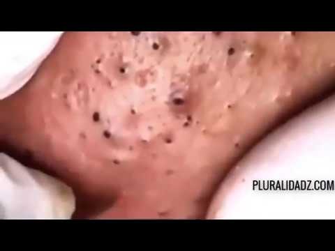 Intense Music Acne Treatment 2 Intense Music Acne Treatment 1