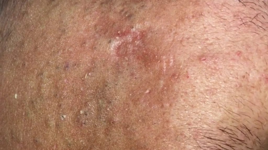 More hidden acne and blackheads 1