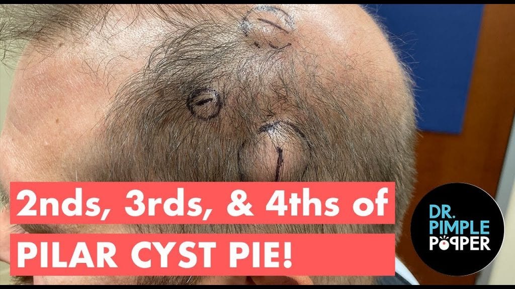 Pilar Cysts - Dr. Pimple Popper 1