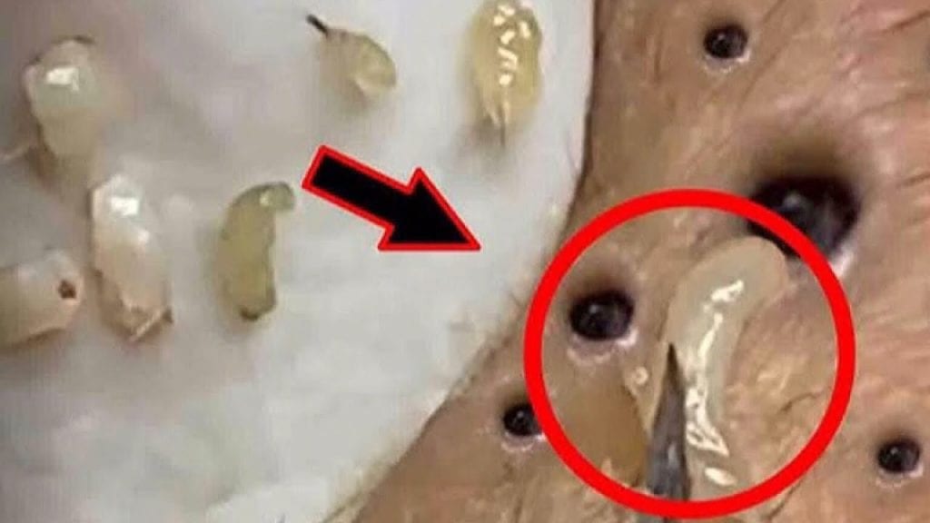 Skincare? Blackheads removal 1