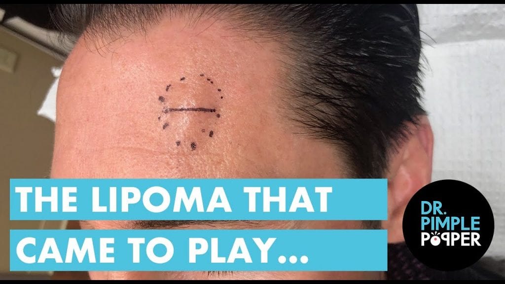 This Lipoma wanted to play 1