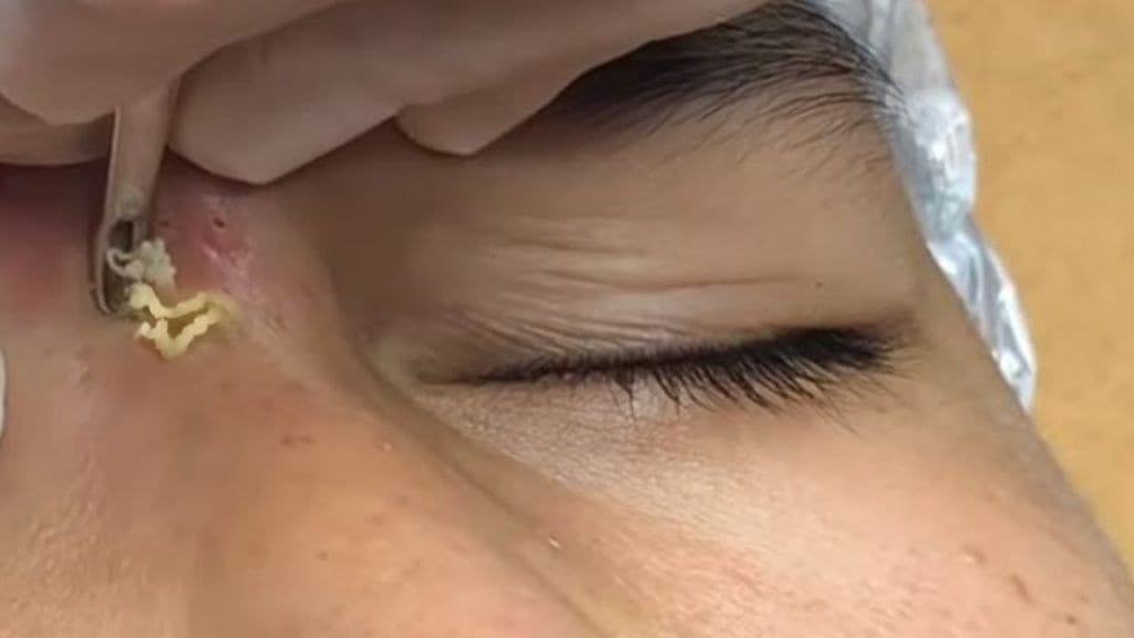 Whitehead and Blackhead Extractions 1