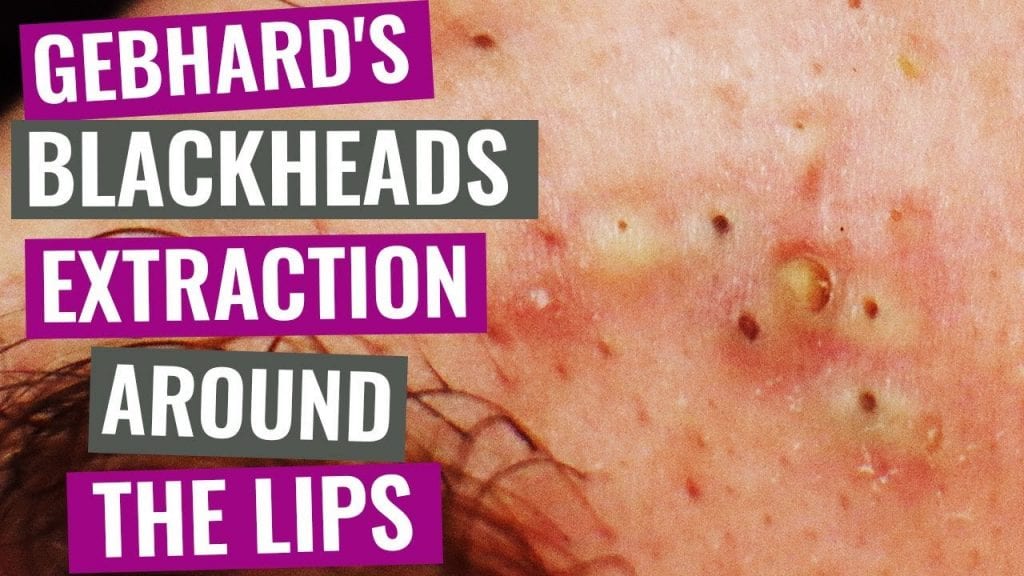 Blackhead extractions around the lip 1
