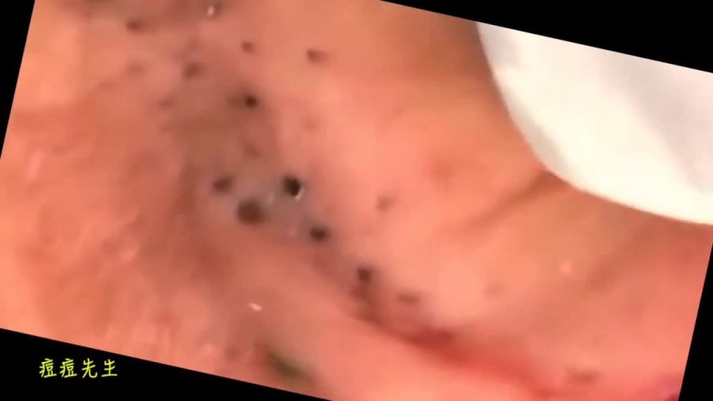 Blackheads Nightmare 1