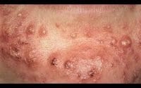 Close up Acne Treatment 3 Close up Acne Treatment 3