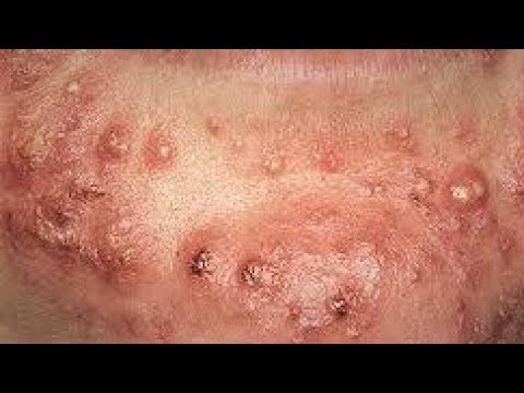 Close up Acne Treatment 2 Close up Acne Treatment 1