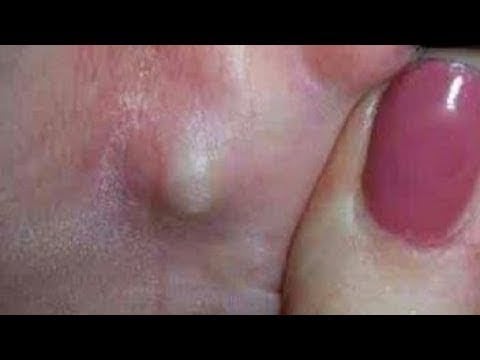 Cyst Squeeze 1
