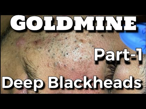 Deep Blackheads 1