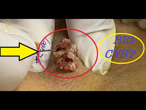 Giant Back Cyst 1