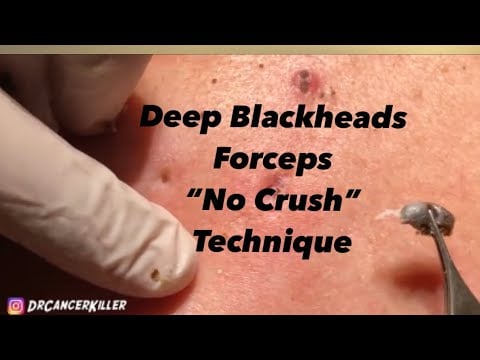 How to NOT handle blackheads 1