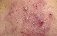 Inflammatory Acne 3 Inflammatory Acne 3