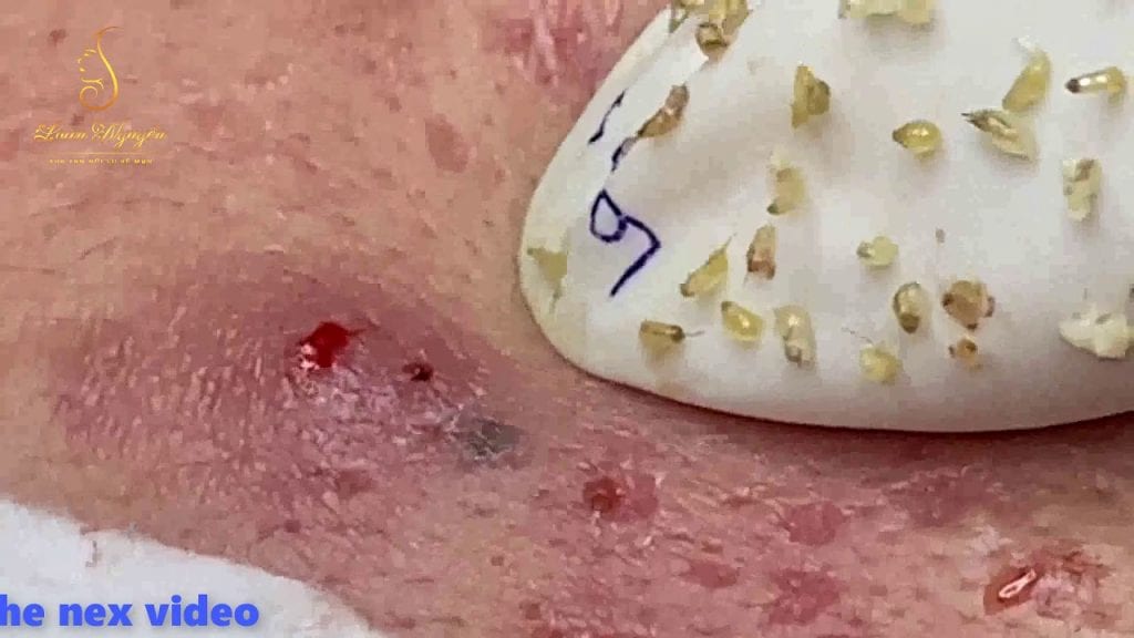 Ingrown Hairs and Blackheads 1