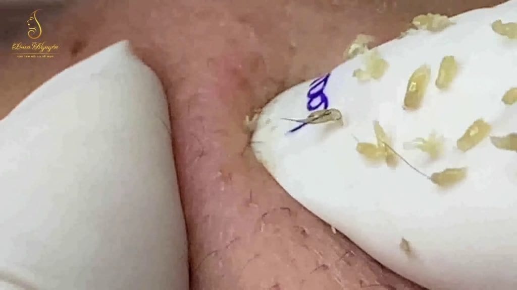 Loan Nguyen Acne Treatment 1