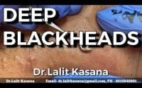 Blackheads removal with Dr Lalit Kasana 1