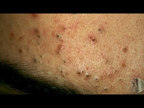 Cleaning out the Pores - Blackheads 1