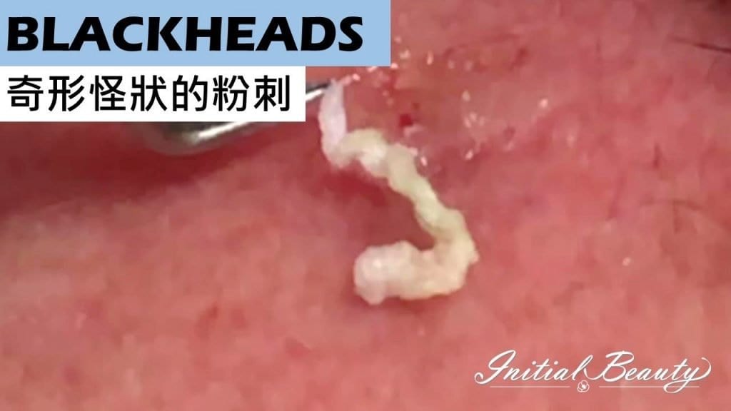 Cleaning up Blackheads 1