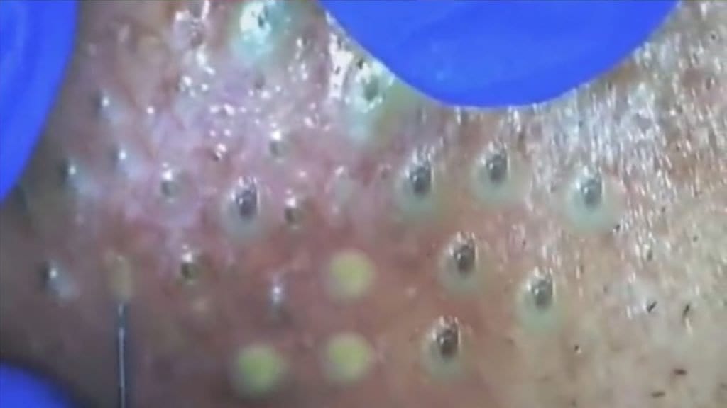 Acne Treated with Qtips 1