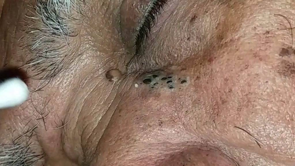 Blackhead Removal 1