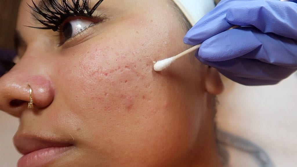 Facial - Pimple Extraction 2 Facial - Pimple Extraction 1