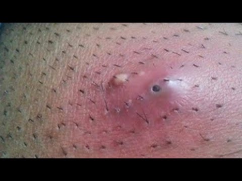 Pimple Popping 1